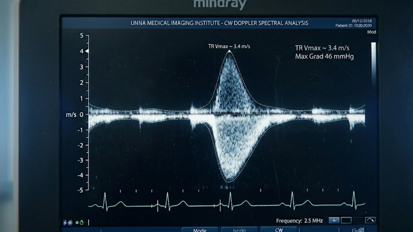 CW-Doppler Trikuspidalinsuffizienz — TR-Velocity-Messung zur Abschätzung des pulmonalarteriellen Drucks